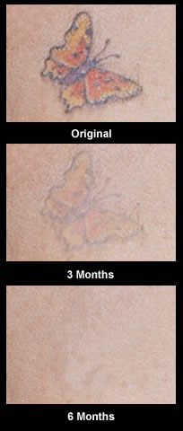 Tattoo fading after using cream- photo by thebeautybrains.com